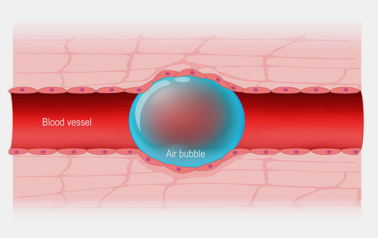 Air Embolism