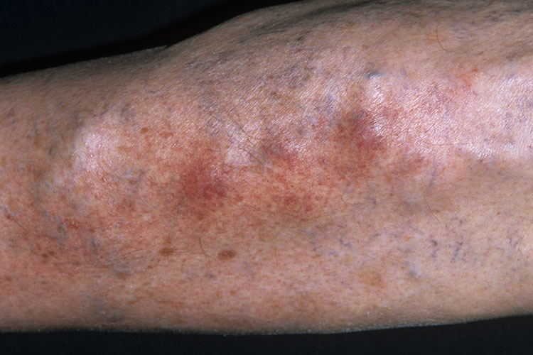 Phlebitis and Thrombophlebitis