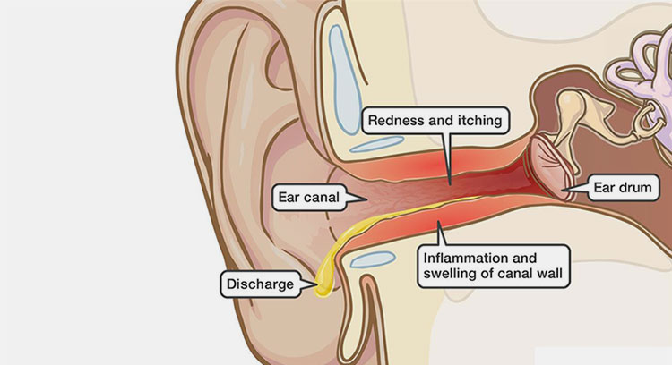 Ear Canal Infection