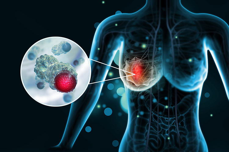 Breast carcinoma