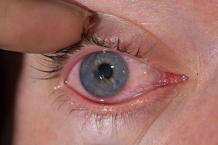 Corneal lesion