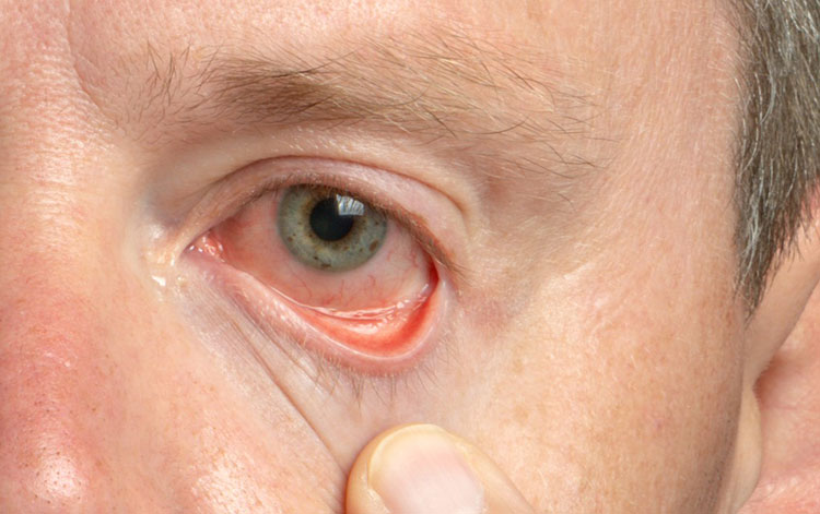 Dry eye disease