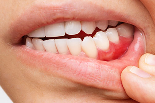 Gum soreness