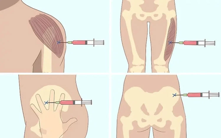 Intramuscular (IM) injection-2