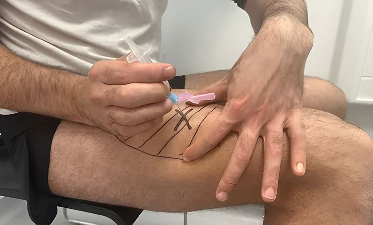 Intramuscular shot