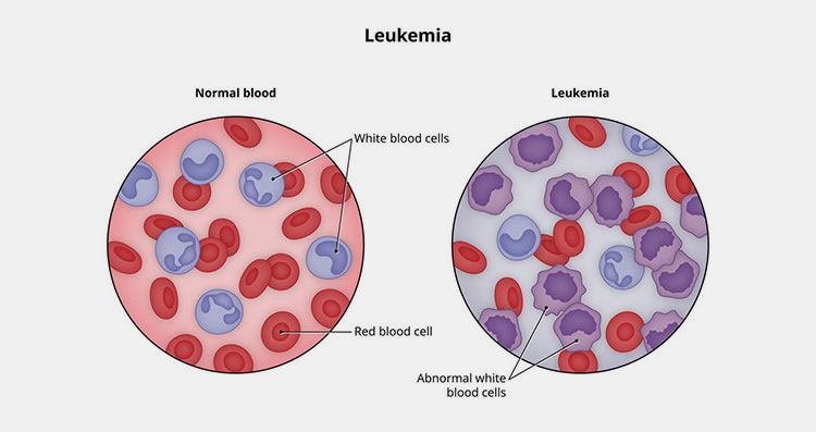 Leukemia