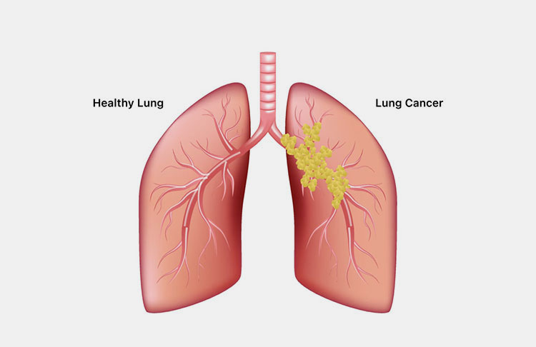 Lung cancer