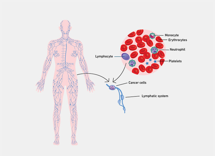 Lymphoma