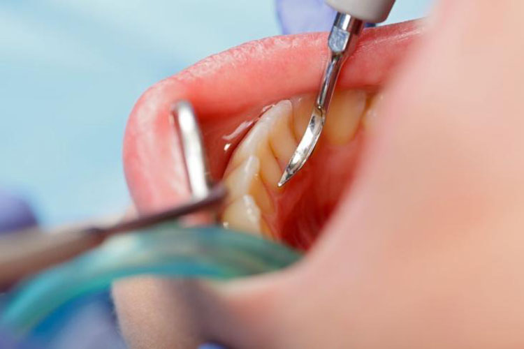 Mild gum disease
