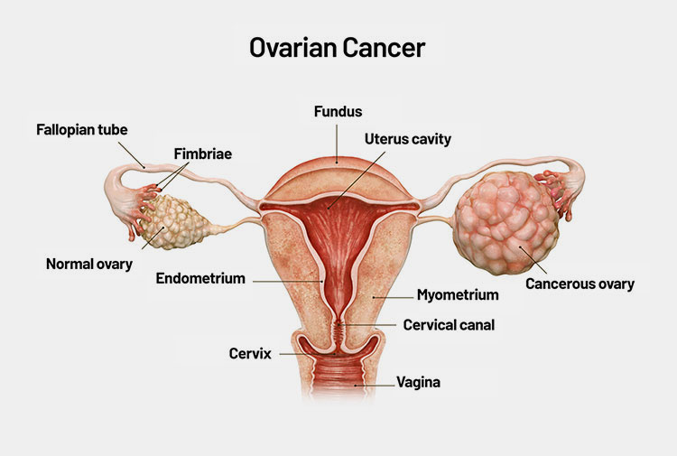 Other Cancers
