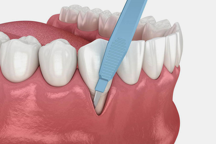Periodontal surgeries