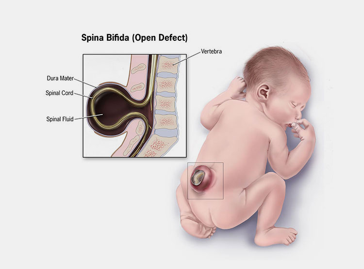 Prevent birth defects