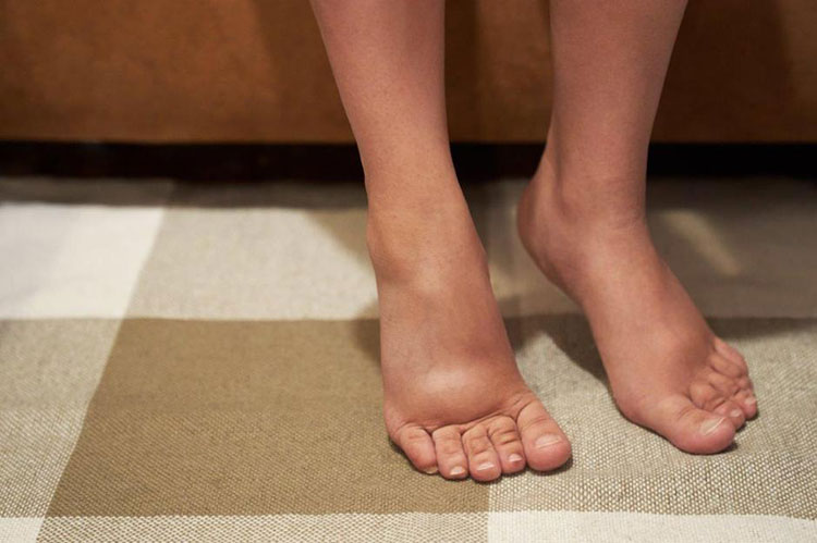 Puffed hands and feet