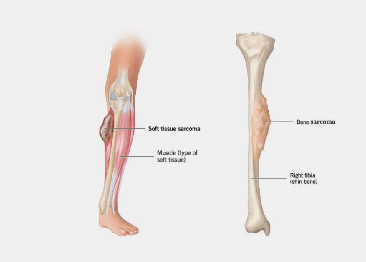 Sarcoma