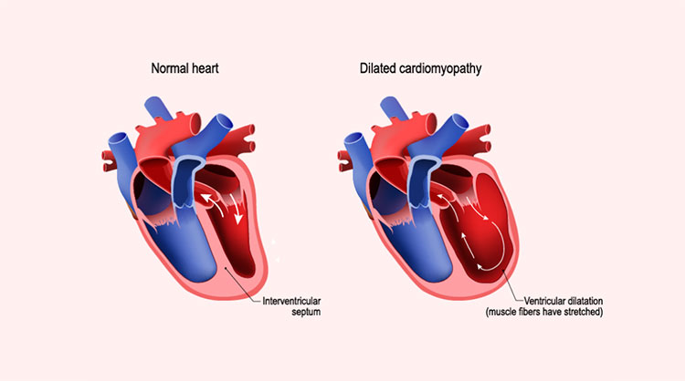 Serious myocardial inadequacy