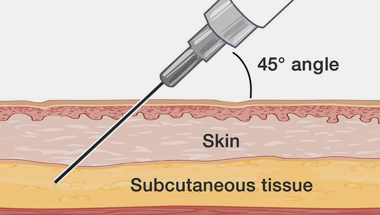Subcutaneous injection