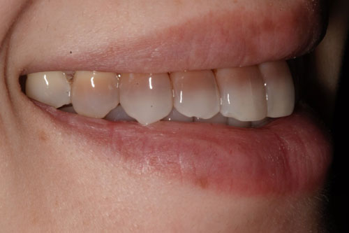 Tooth discoloration