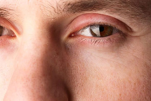 swelling in the eyelids