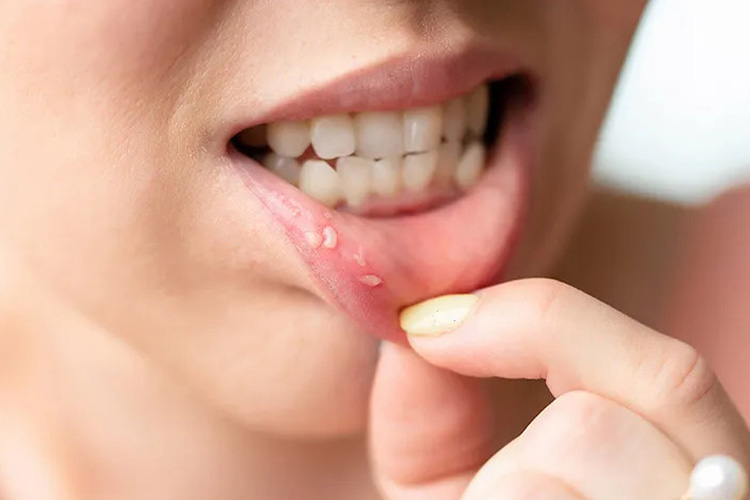 Treating-mucosal-inflammation-of-the-tongue,-mouth,-and-digestive-tract