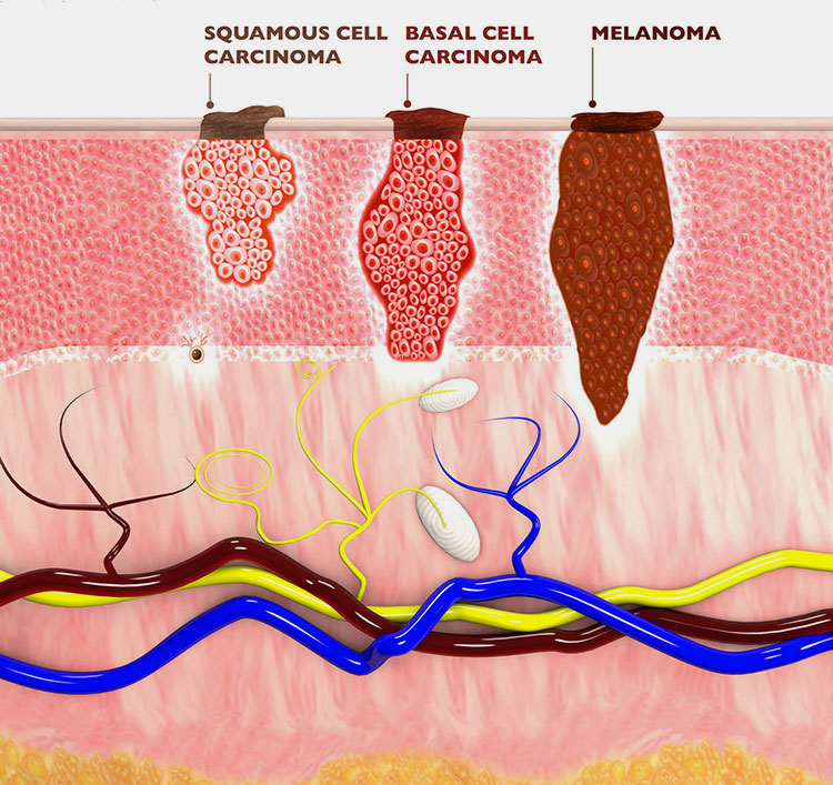 A rapid growing tumor