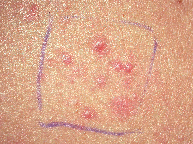 Allergic reactions