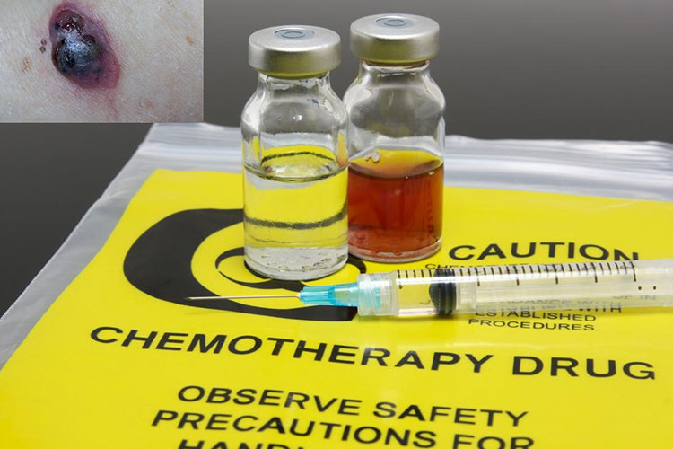 Effectiveness of chemotherapy drugs for metastatic melanoma
