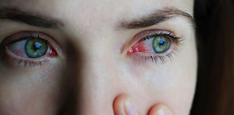 Eyes irritation
