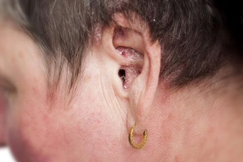 Flaking of outer ear skin