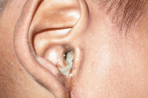 Flow of ear discharge