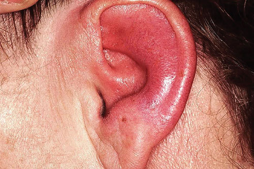 Inflamed & swollen ear