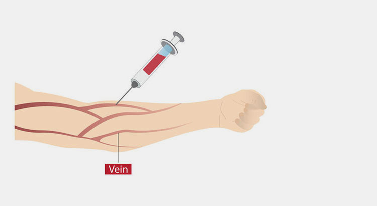 Intravenous infusion