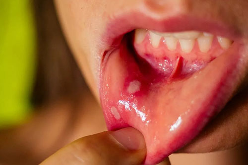 Mouth sores