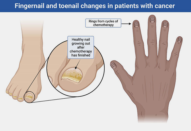 Nail changes