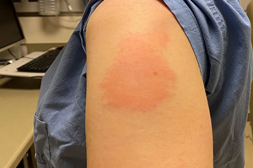 Pain and swelling at site of injection