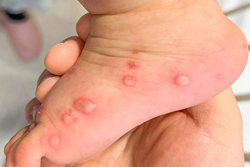Rashes