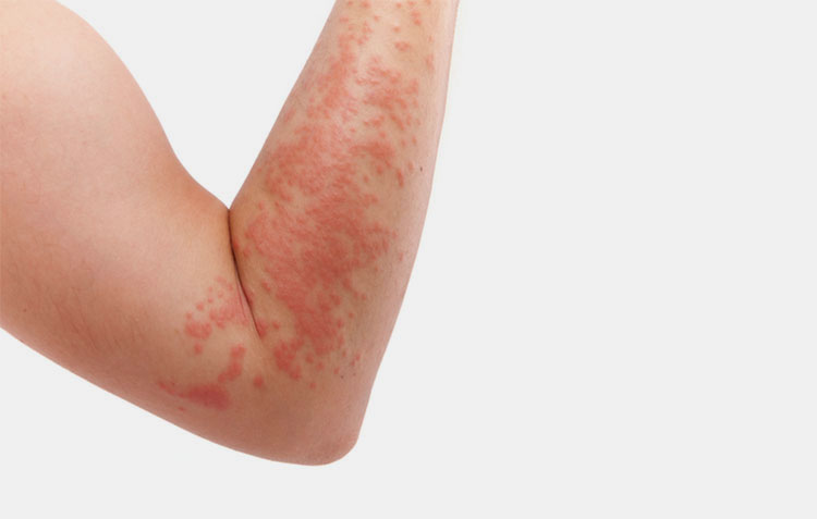 Skin irritation