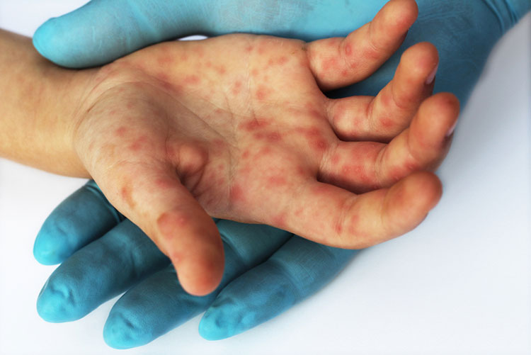 foot and mouth disease-1