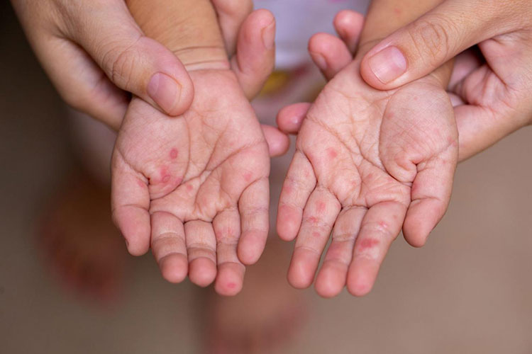 foot and mouth disease