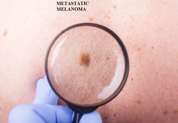 metastatic melanoma