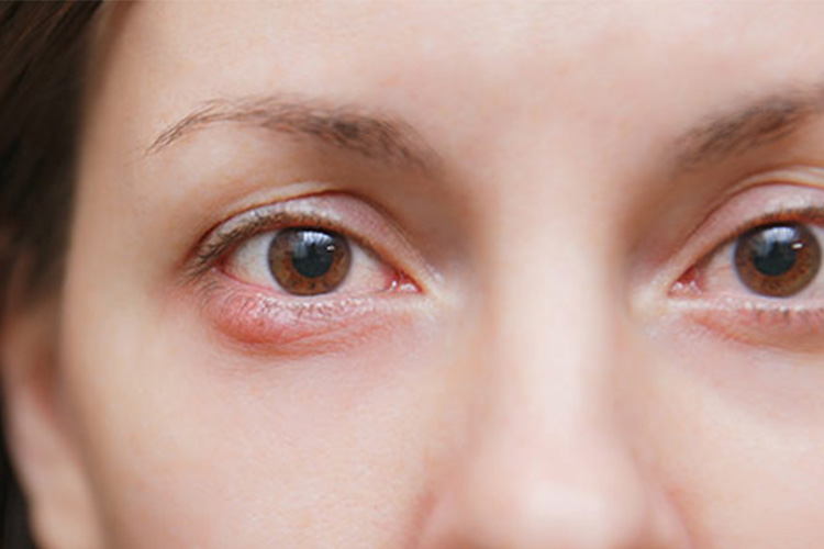 Improving-symptoms-of-eye-inflammation