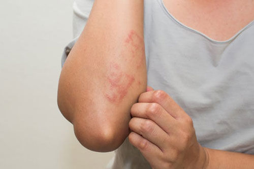 Allergic Skin Irritation