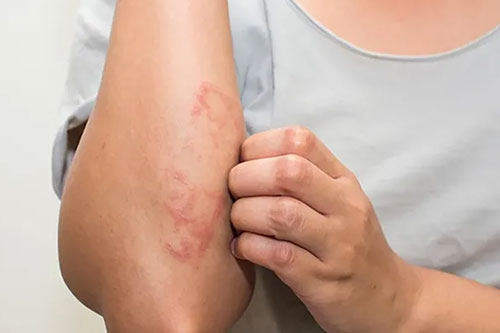 Allergic reactions