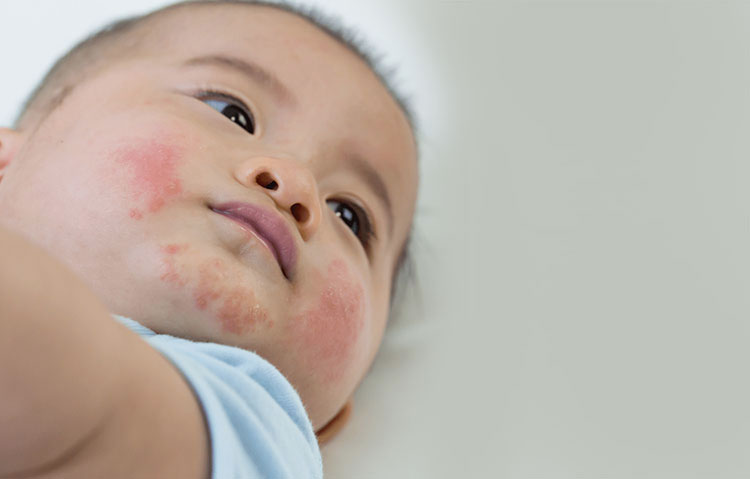 Allergic reactions