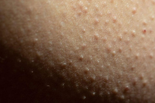 Bumpy Skin