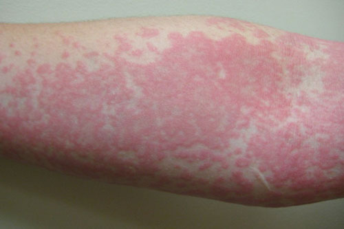 Cold-Induced Urticaria