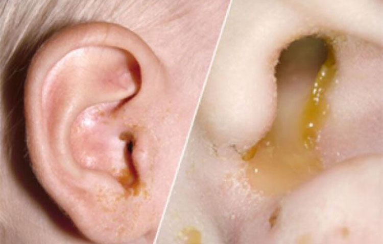 Discharge from ear