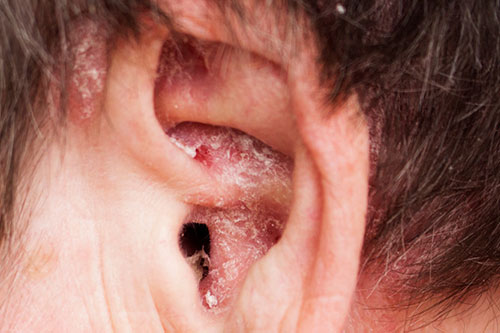 Dryness inside the ear