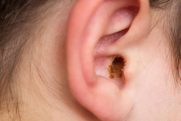 Earwax softening