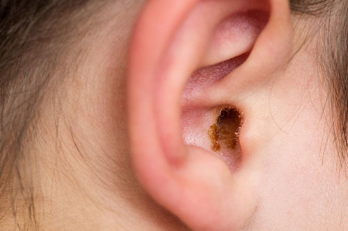 Full or blocked ear