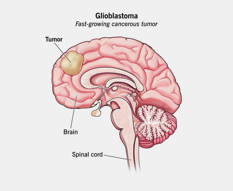 GBM Chemotherapy